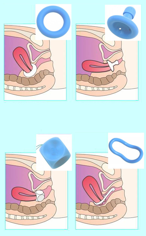 Постановка разных пессариев