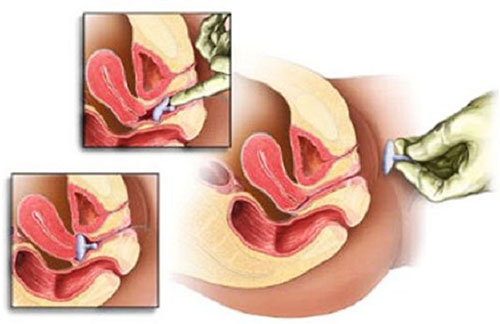 Как гинеколог ставит пессарий